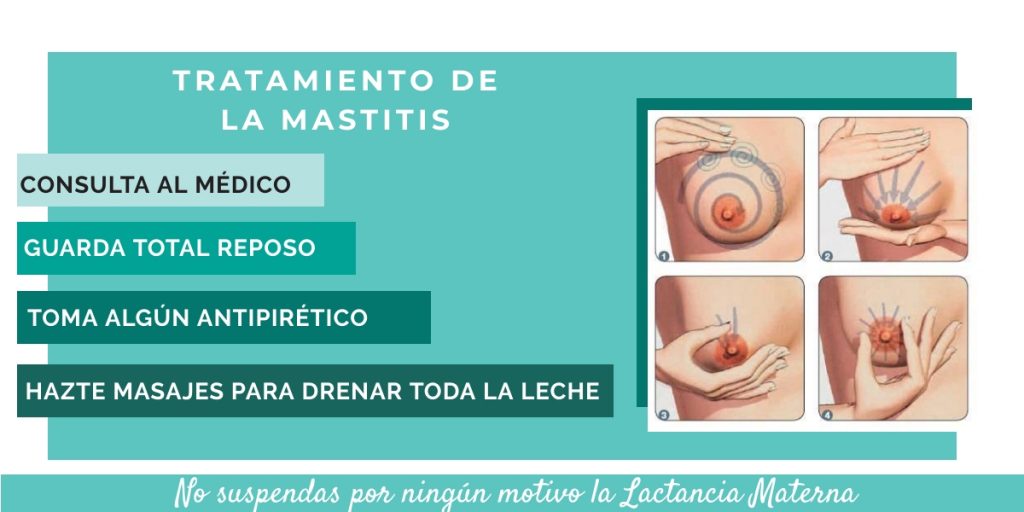 mastitis tratamiento - lactancia materna